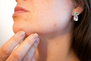 how-to-remove-pimple