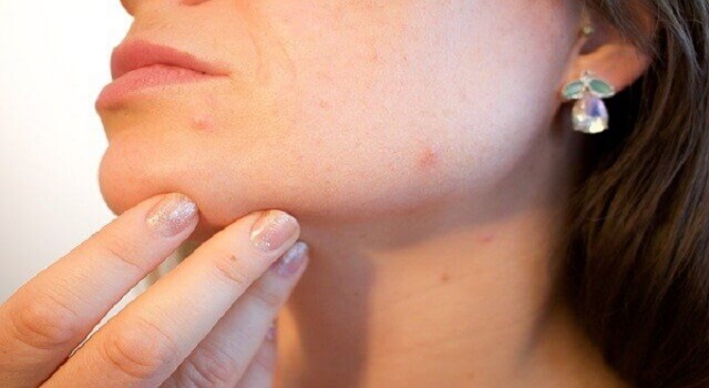 how to remove pimples from face